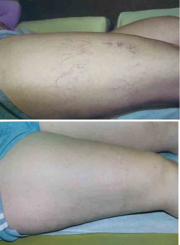 Spider Vein Sclerotherapy Treatment